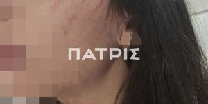 Η 29χρονη που ξυλοκοπήθηκε άγρια από τον σύντροφό της
