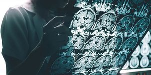 Χάπι που επιβραδύνει το Αλτσχάιμερ εξετάζει προς έγκριση το βρετανικό ΕΣΥ 