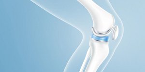 Μονοδιαμερισματική αρθροπλαστική γόνατος: Πώς ανακουφίζει από τον πόνο