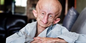 Η 19χρονη Μπεάντρι που πάσχει από προγηρία 