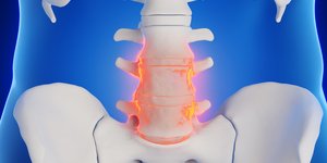 Aξονική σπονδυλαρθρίτιδα