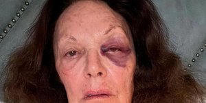 Το μαυρισμένο μάτι της Diane Von Furstenberg