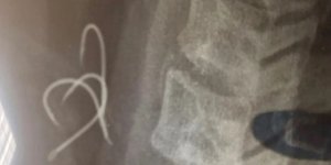 38yo man from Agrinio was hospitalized in Athens after swallowing a fishhook concealed in an octopus he ate