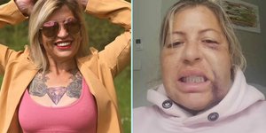 Η Βίκυ Ρόμπινσον πριν και μετά την επέμβαση ατην Τουρκία