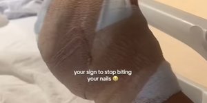 Τι έπαθε μια γυναίκα που δεν σταματούσε να δαγκώνει τα νύχια της
