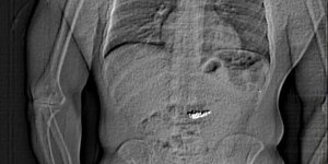 Ακτινογραφία κλέφτη που κατάπιε σκουλαρίκια