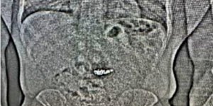 σκουλαρίκια, ακτινογραφία