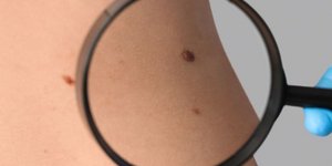 Σπίλοι: Πότε να μας ανησυχήσει μια ελιά στο δέρμα;