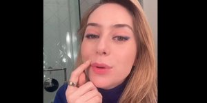 Η δημοφιλής θεραπεία Botox lip flip - Ποιες είναι οι παρενέργειές της