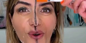 Γιατρός έκανε botox μόνο στη μία πλευρά του προσώπου της για να δείξει τη διαφορά