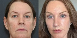 Η 66χρονη Τίνα Χίτον υποβλήθηκε σε λίφτινγκ. Πώς ήταν και πώς έγινε 