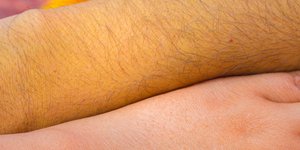 Ο περίεργος χρωματισμός στην επιδερμίδα μπορεί να αποτελεί ένδειξη για τη νόσο του λιπώδους ήπατος