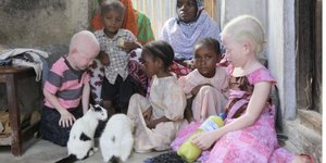 Τα άτομα με αλμπινισμό αντιμετωπίζουν ευρέως διαδεδομένες διακρίσεις σε πολλές χώρες της υποσαχάριας Αφρικής / WIKIPEDIA