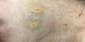 Φωτογραφίες ντοκουμέντα: Τα σημάδια των βασανιστηρίων των απαγωγέων στον 24χρονο γιο χρυσοχόου