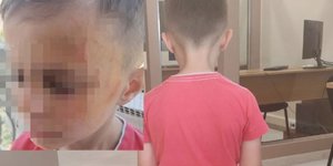 O 5χρονος που ξυλοκοπήθηκε στο Αγρίνιο