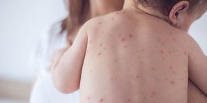 υπάρχει λόγος να επανεξεταστεί ο χρόνος χορήγησης των εμβολίων κατά της ιλαράς; / SHUTTERSTOCK