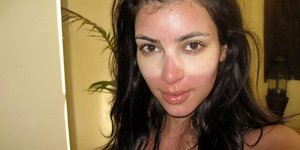 Η Κιμ Καρντάσιαν επιδεικνύει ένα πρόσφατο έγκαυμα από τον ήλιο / INSTAGRAM