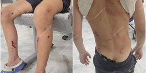 Τα τραύματα στο σώμα του 7χρονου μετά την επίθεση από αδέσποτα