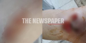 Τα τραύματα της γυναίκας δικυκλίστριας στο Βόλο