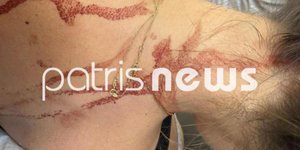 Αμαλιάδα: Τρομακτικό σκηνικό -Την κυνήγησε απειλώντας την με ψαλίδι και την έστειλε στο νοσοκομείο