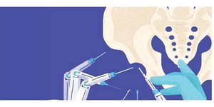 Ρομποτική αρθοπλαστική ισχίου