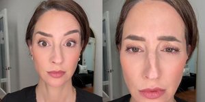 Έκανε botox στο μισό πρόσωπό της και έδειξε τα αποτελέσματα