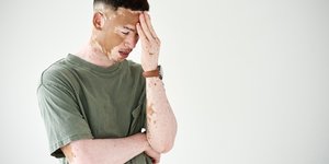 Άνδρας με λεύκη