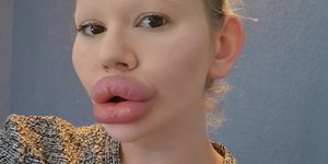 Η γυναίκα με τα «μεγαλύτερα χείλη στον κόσμο»