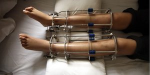 Η επέμβαση μοιάζει με μεσαιωνικό βασανιστήριο: κόβουν τα μηριαία οστά και βάζουν μεταλλικές ράβδους / SHUTTERSTOCK