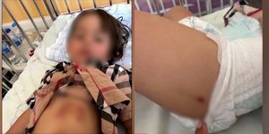 Οι εκδορές και τα τραύματα της 5χρονης