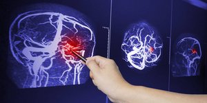 H μεταμόσχευση νευρικών βλαστοκυττάρων μπορεί να αναγεννήσει τον εγκέφαλο μετά από εγκεφαλικό / SHUTTERSTOCK