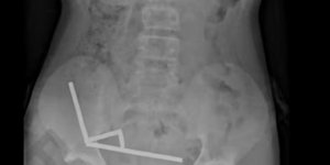 13χρονος στη Νέα Ζηλανδία κατάπιε δεκάδες μαγνήτες