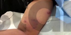 Επίθεση σκύλου σε 12χρονο στο Πέραμα