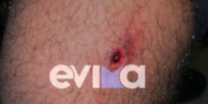 Αδέσποτα σκυλιά επιτέθηκαν σε 25χρονο στην Εύβοια