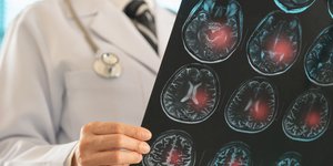 Εγκεφαλικό