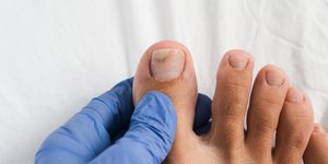 Μύκητες στα νύχια; Πώς αντιμετωπίζονται και πώς θα τους προλάβετε