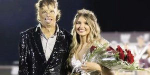 Σε ηλικία 18 μηνών υπέστη εγκαύματα σε όλο το σώμα του, αλλά χάρη στην επιμονή του δεν το έβαλε ποτέ κάτω 