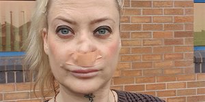 Η 41χρονη Βρετανίδα που πήγε στην Τουρκία για νέα δόντια