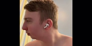 Πριν την διπλή επέμβαση γνάθου