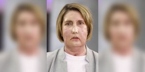 Γιατροί στην Ισπανία έγραψαν ιστορία: Η πρώτη μεταμόσχευση προσώπου με δότρια που υποβλήθηκε σε υποβοηθούμενη ευθανασία