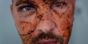 Βαριά τραυματίας του πολέμου στην Ουκρανία