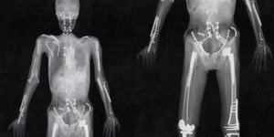 Σοκάρει η ακτινογραφία αθλητή