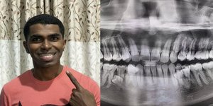 Ένας 33χρονος από τη Μαλαισία κατέκτησε μια ασυνήθιστη θέση στο βιβλίο των παγκόσμιων ρεκόρ, καθώς διαθέτει συνολικά 42 δόντια / FACEBOOK