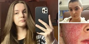 Η Bethany Gamble ξεκίνησε να χρησιμοποιεί στεροειδείς κρέμες από την ηλικία των δύο ετών για να ελέγξει το έκζεμά της / FACEBOOK