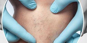 Σκληροθεραπεία: Μια αξιόπιστη λύση για την εξάλειψη των ευρυαγγειών