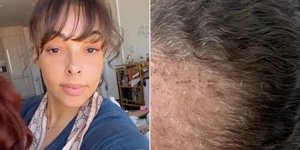 Influencer έκανε μεταμόσχευση μαλλιών - Την παρενέργεια αυτή δεν την φανταζόταν