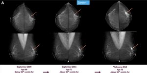 CREDIT: Radiological Society of North America (RSNA)