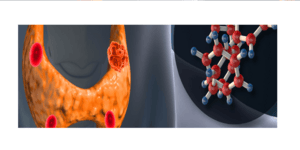 Πρωτοπαθής υπερπαραθυρεοειδισμός