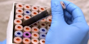 Αιματολογική εξέταση για την έγκαιρη διάγνωση του Αλτσχάιμερ