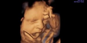 Και όμως και τα έμβρυα χασμουριούνται! [βίντεο]